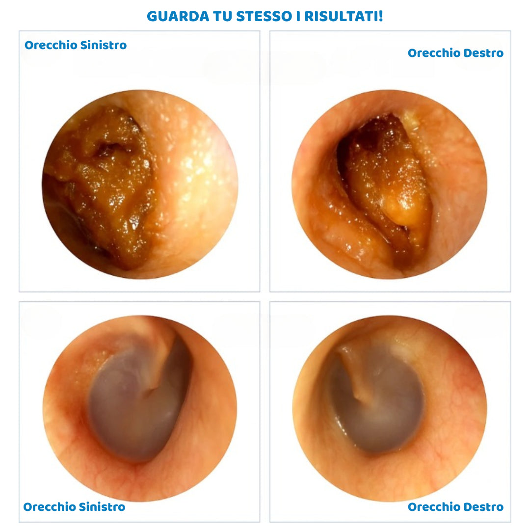 BeClean View - Per una pulizia auricolare consapevole